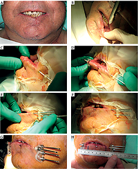 Pictorial essay: High-dose-rate brachytherapy (interventional radiotherapy) in lip carcinoma with rigid needles: 
a simple technique with excellent results